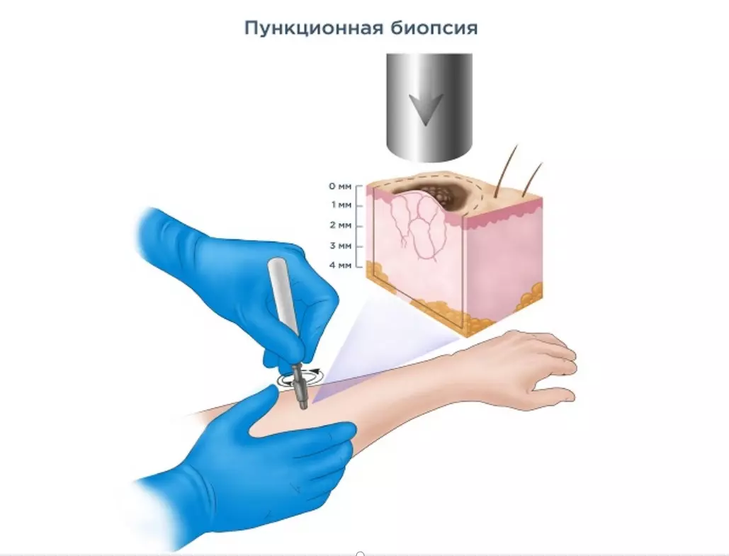 Как проводят пункцию костного мозга у детей: показания, подготовка и восстановление0